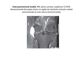 Cisto parameniscal medial. RM, plano coronal, seqüência T2 SPIR,
demonstrando formação cística na região da interlinha articular medial
comunicando-se com rotura meniscal (seta).
 