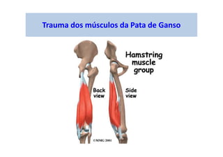Trauma dos músculos da Pata de Ganso
 