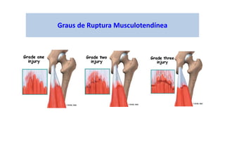 Graus de Ruptura Musculotendínea
 