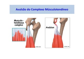 Avulsão do Complexo Músculotendíneo
 