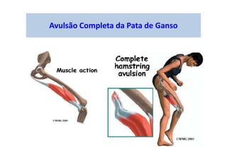 Avulsão Completa da Pata de Ganso
 