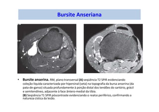 Bursite Anseriana
• Bursite anserina. RM, plano transversal (A) seqüência T2 SPIR evidenciando
coleção líquida caracterizada por hipersinal (seta) na topografia da bursa anserina (da
pata-de-ganso) situada profundamente à porção distal dos tendões do sartório, grácil
e semitendíneo, adjacente à face ântero-medial da tíbia.
(B) Seqüência T1 SPIR póscontraste evidenciando o realce periférico, confirmando a
natureza cística da lesão.
 