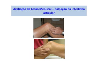 Avaliação da Lesão Meniscal – palpação da interlinha
articular
 