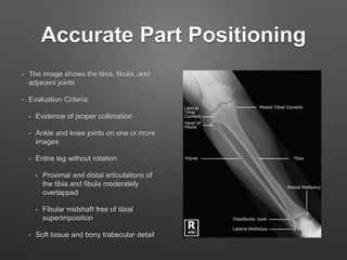 D torres lower_leg_oralppt3 | PPTX