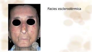 Facies esclerodérmica
 