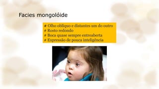 Facies mongolóide
# Olho oblíquo e distantes um do outro
# Rosto redondo
# Boca quase sempre entreaberta
# Expressão de pouca inteligência
 