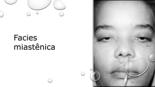Facies
miastênica
 