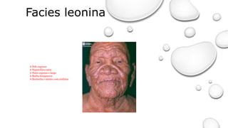 Facies leonina
# Pele espessa
# Supercílios caem
# Nariz espesso e largo
# Barba desaparece
# Bochecha e mento com nódulos
 