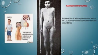 Paciente de 16 anos,apresentando altura
de 1,20m,imberbe,sem caracteres sexuais
secundários
NANISMO HIPOFISÁRIO
 