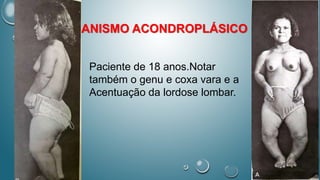 NANISMO ACONDROPLÁSICO
Paciente de 18 anos.Notar
também o genu e coxa vara e a
Acentuação da lordose lombar.
 