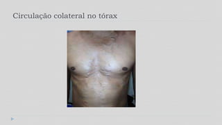 Circulação colateral no tórax
 