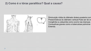 2) Como é o tórax paralítico? Qual a causa?
Diminuição nítida do diâmetro ântero-posterior,com
Predominância do diâmetro vertical.Pode ser de ori
Congênita ou adquirida como ocorre nas doenças
Consuptivas graves como a tuberculose pulmonar
Extensa.
 