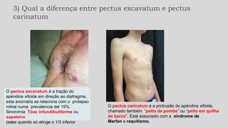 3) Qual a diferença entre pectus excavatum e pectus
carinatum
O pectus excavatum é a tração do
apéndice xifoide em direção ao diafragma,
esta anomalía se relaciona com o prolapso
mitral numa prevalencia del 15%.
Sinonímia: Tóax infundibuliforme ou
sapateiro
(esse quando só atinge o 1/3 inferior
O pectus carinatum é a protrusão do apéndice xifoide,
chamado também “peito de pomba” ou “peito em quilha
de barco”. Está associado com a síndrome de
Marfan e raquitismo.
 