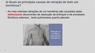 4) Quais as principais causas de retração de todo um
hemitórax?
 As mais intensas retrações de um hemitórax são causadas pelas
atelectasias decorrentes de obstrução de brônquio e de processos
fibróticos extensos , tanto pulmonares quanto pleurais
Retração do
hemitórax
esquerdo por
paquipleuris
 