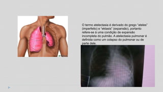 O termo atelectasia é derivado do grego “ateles”
(imperfeito) e “ektasis” (expansão), portanto
refere-se à uma condição de expansão
incompleta do pulmão. A atelectasia pulmonar é
definida como um colapso do pulmonar ou de
parte dele.
 