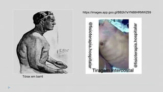 Tórax em barril
https://images.app.goo.gl/BB2k7eYN88HRMWZ69
 