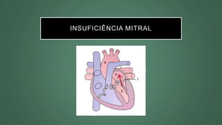 INSUFICIÊNCIA MITRAL
 