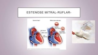ESTENOSE MITRAL-RUFLAR-
 