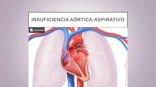 INSUFICIENCIA AÓRTICA-ASPIRATIVO
 