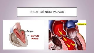 INSUFICIÊNCIA VALVAR
Ins Aórtica
 