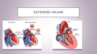 ESTENOSE VALVAR
 
