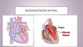 REGURGITAÇÃO MITRAL
 