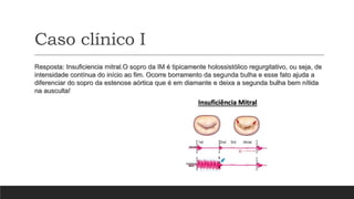 Caso clínico I
Resposta: Insuficiencia mitral.O sopro da IM é tipicamente holossistólico regurgitativo, ou seja, de
intensidade contínua do início ao fim. Ocorre borramento da segunda bulha e esse fato ajuda a
diferenciar do sopro da estenose aórtica que é em diamante e deixa a segunda bulha bem nítida
na ausculta!
 