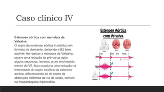 Caso clinico IV
Estenose aórtica com manobra de
Valsalva
O sopro da estenose aórtica é sistólico em
formato de diamante, deixando a B2 bem
audível. Ao realizar a manobra de Valsalva,
ocorre uma redução da pré-carga após
alguns segundos, levando a um enchimento
menor do VE. Isso ocasiona uma redução na
intensidade do sopro sistólico da estenose
aórtica, diferenciando-se do sopro da
obstrução dinâmica da via de saída, comum
na miocardiopatia hipertrófica.
 