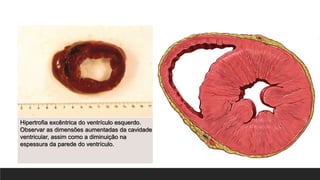Hipertrofia excêntrica do ventrículo esquerdo.
Observar as dimensões aumentadas da cavidade
ventricular, assim como a diminuição na
espessura da parede do ventrículo.
 