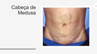 Veia Paraumbilical Cabeca Medusa