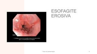ESOFAGITE
EROSIVA
Título da apresentação 6
 