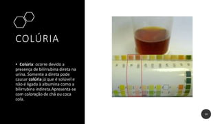 COLÚRIA
• Colúria: ocorre devido a
presença de bilirrubina direta na
urina. Somente a direta pode
causar colúria já que é solúvel e
não é ligada à albumina como a
bilirrubina indireta.Apresenta-se
com coloração de chá ou coca
cola.
10
 
