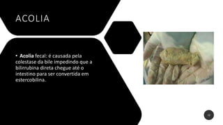 ACOLIA
• Acolia fecal: é causada pela
colestase da bile impedindo que a
bilirrubina direta chegue até o
intestino para ser convertida em
estercobilina.
12
 