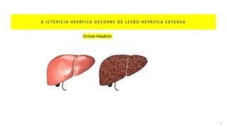 A I C T E R Í C I A H E PÁT I C A D E C O R R E D E L E S Ã O H E PÁT I C A E X T E N S A
6
Cirrose Hepática
 