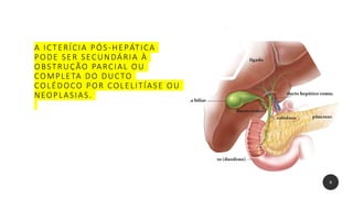 A ICTERÍCIA PÓS-HEPÁTICA
PODE SER SECUNDÁRIA À
OBSTRUÇÃO PARCIAL OU
COMPLETA DO DUCTO
COLÉDOCO POR COLELITÍASE OU
NEOPLASIAS.
8
 