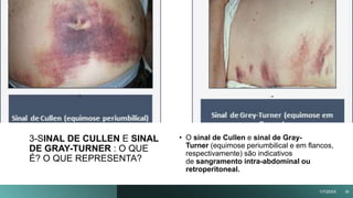 3-SINAL DE CULLEN E SINAL
DE GRAY-TURNER : O QUE
É? O QUE REPRESENTA?
Título
da
apresentação
• O sinal de Cullen e sinal de Gray-
Turner (equimose periumbilical e em flancos,
respectivamente) são indicativos
de sangramento intra-abdominal ou
retroperitoneal.
1/7/20XX 30
 