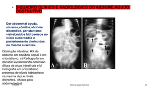 • 5-QUADRO CLÍNICO E RADIOLÓGICO DO ABDOME AGUDO
OBSTRUTIVO
1/7/20XX Abdome agudo Obstrutivo 32
Dor abdominal aguda,
náuseas,vômitos,abdome
distendido, peristaltismo
visível,ruídos hidroaéreos no
início aumentados e
posteriormente diminuidos
ou mesmo ausentes.
Obstrução intestinal. RX de
abdome em decúbito dorsal e em
ortostatismo. a) Radiografia em
decúbito evidenciando distensão
difusa de alças intestinais e b)
radiografia em ortostatismo:
presença de níveis hidroaéreos
na mesma alça e níveis
diferentes, difusos pelo
abdome(setas)
 