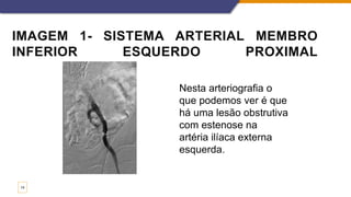IMAGEM 1- SISTEMA ARTERIAL MEMBRO
INFERIOR ESQUERDO PROXIMAL
14
Nesta arteriografia o
que podemos ver é que
há uma lesão obstrutiva
com estenose na
artéria ilíaca externa
esquerda.
 