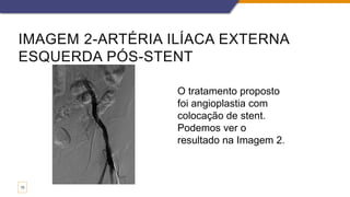 IMAGEM 2-ARTÉRIA ILÍACA EXTERNA
ESQUERDA PÓS-STENT
15
O tratamento proposto
foi angioplastia com
colocação de stent.
Podemos ver o
resultado na Imagem 2.
 