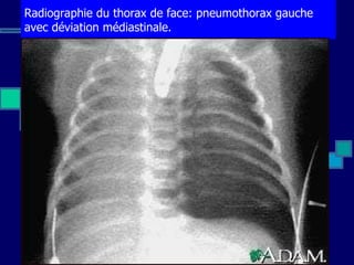 Radiographie du thorax de face: pneumothorax gauche avec déviation médiastinale. Pictures & Images                        ...
