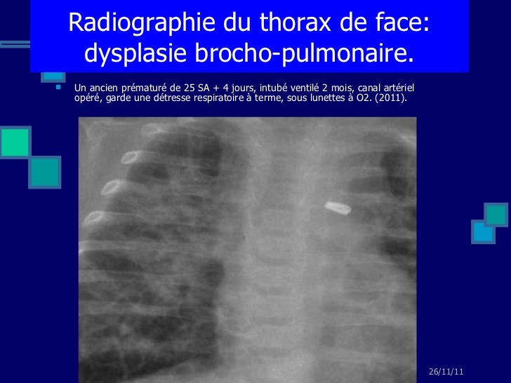 Définition Accentuation De La Trame Broncho Vasculaire