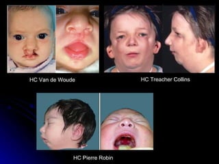 dị tật bẩm sinh hàm mặt.pdf