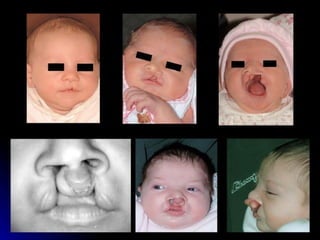 dị tật bẩm sinh hàm mặt.pdf