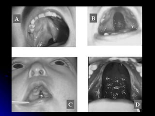 dị tật bẩm sinh hàm mặt.pdf