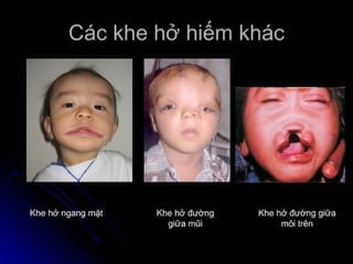 dị tật bẩm sinh hàm mặt.pdf
