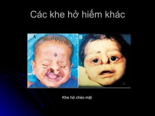 dị tật bẩm sinh hàm mặt.pdf