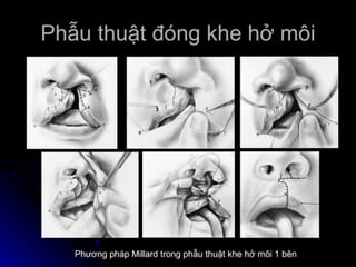 dị tật bẩm sinh hàm mặt.pdf