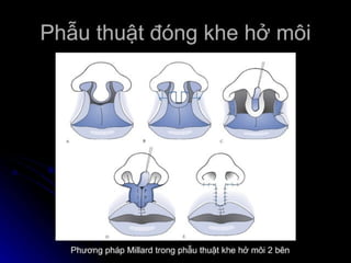 dị tật bẩm sinh hàm mặt.pdf