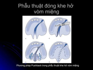 dị tật bẩm sinh hàm mặt.pdf
