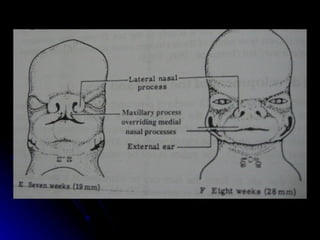 dị tật bẩm sinh hàm mặt.pdf